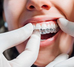 Dentist putting clear aligner on patient