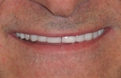 Smile with seamlessly repaired front tooth