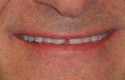 Smile with broken front tooth