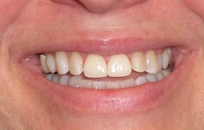 Beautiful smile after top front teeth are repaired
