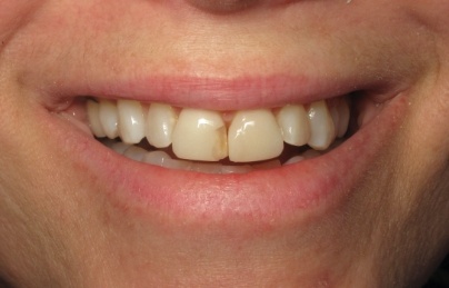 Smile with damaged and discolored top front teeth