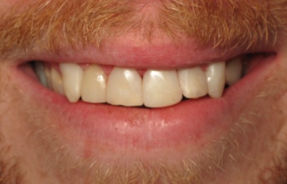 Smile with flawlessly repaired teeth