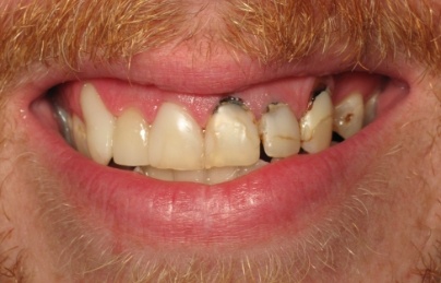 Row of three teeth with severe decay at the gum line