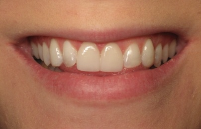 Beautiful bright smile after cosmetic dentistry