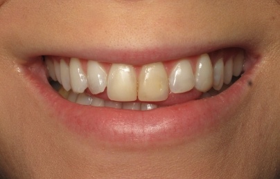 Smile with yellow top front teeth before cosmetic dentistry