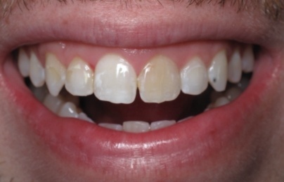 Smile with damaged and discolored top teeth