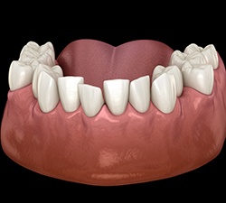 Illustration of crowded teeth 