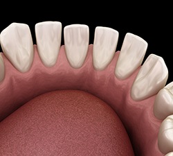 Illustration of tooth gaps 