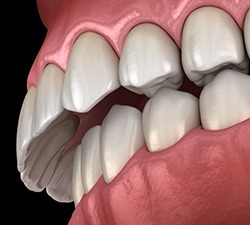 Illustration of an overbite 