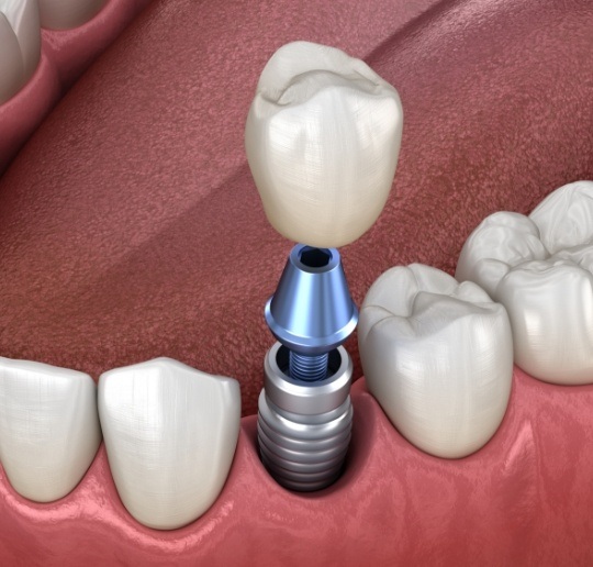 Animated smile during dental implant supported dental crown placement