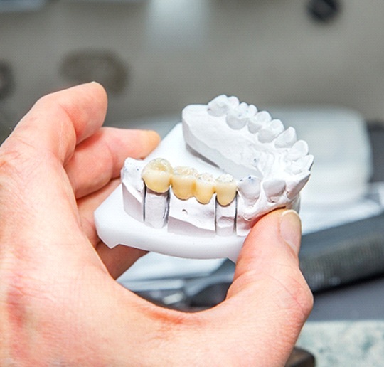 Dental bridge in Gahanna on clay mold