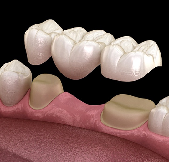 Digital illustration of dental bridge in Gahanna