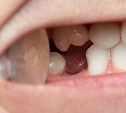 Smile with knocked out tooth
