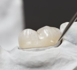 Model smile with new dental crown to replace lost restoration