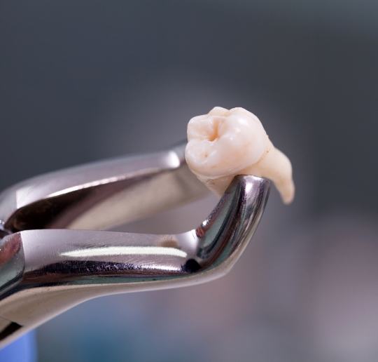 Clasp holding an extracted tooth