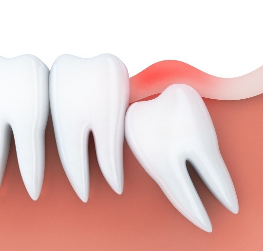 Animated smile with impacted wisdom tooth