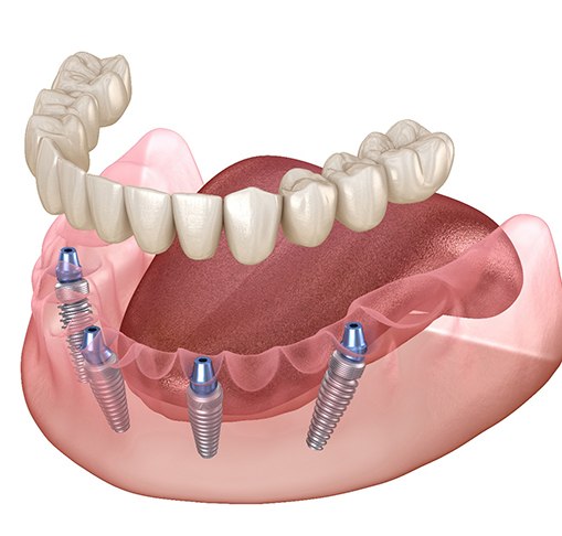 Illustration of implant dentures in Gahanna, OH being attached