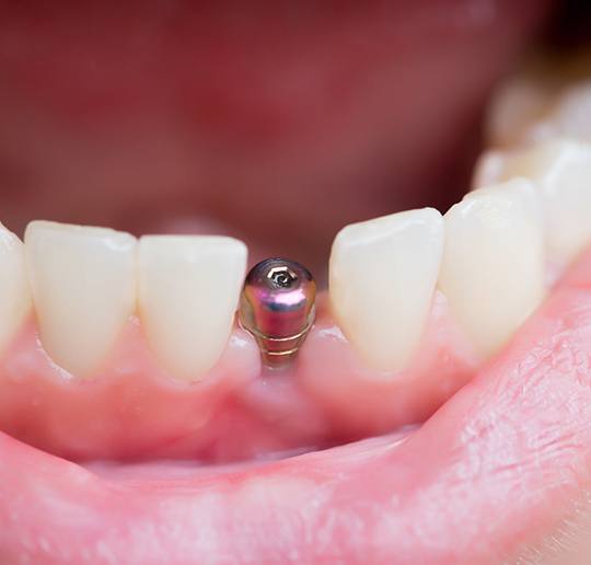 closeup of patient smiling with dental implant 