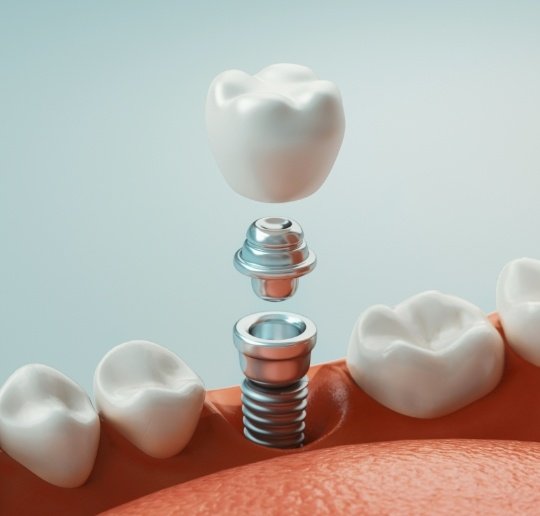 Animated dental implant supported dental crown placement