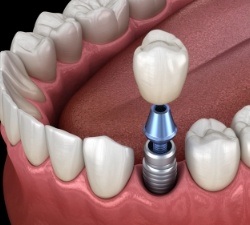 Animated dental implant supported dental crown placement