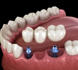 Dental implant supported fixed bridge placement