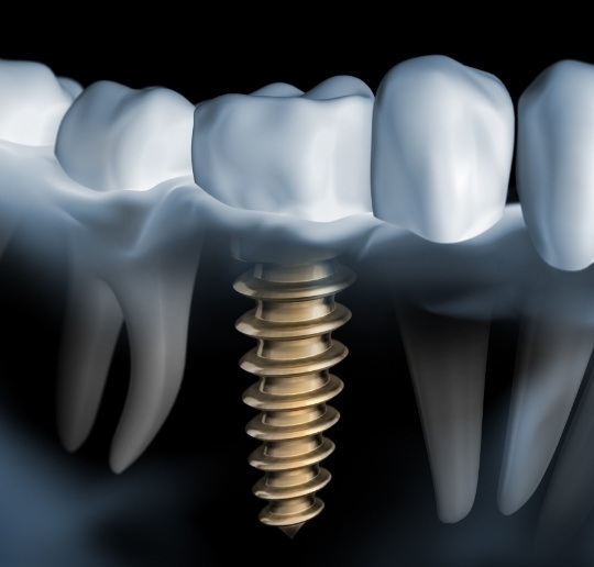 Animated smile with dental implant supported dental crown