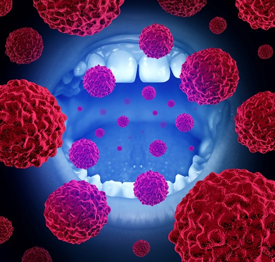 Illustration of oral cancer cells attacking mouth