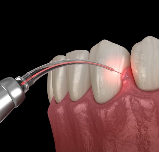 Animated smile during periodontal therapy