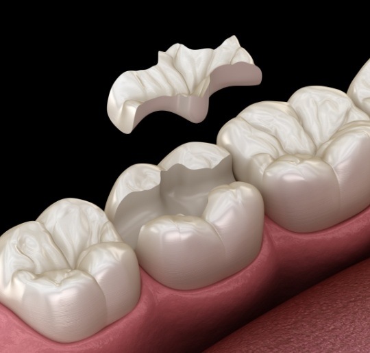 Animated smile during tooth colored filling placement