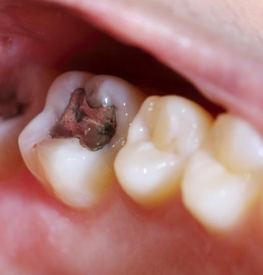 Closeup of smile with metal filling and tooth colored filling