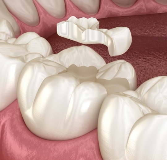 Animated smiling during tooth colored filling treatment