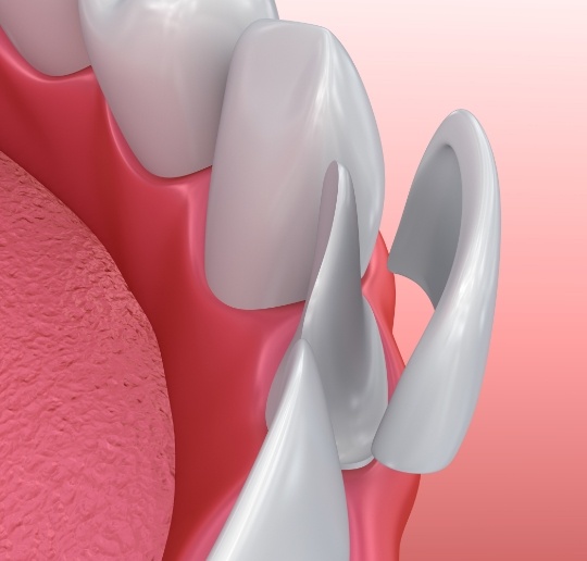 Animated smile during porcelain veneer placement