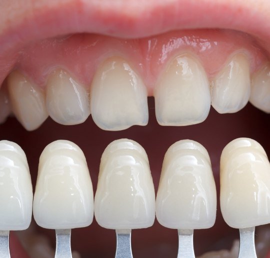 Smile compared to porcelain veneer options