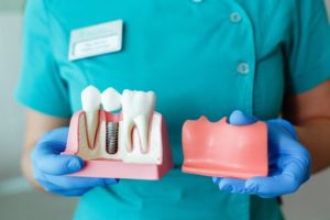 woman holding dental implant model