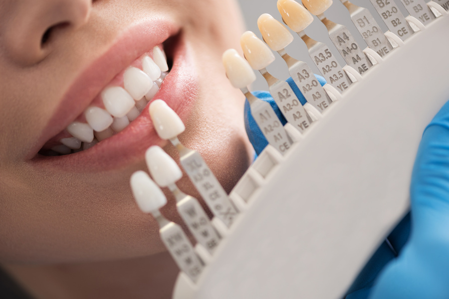 close up of woman having teeth shade selected with color matching guide
