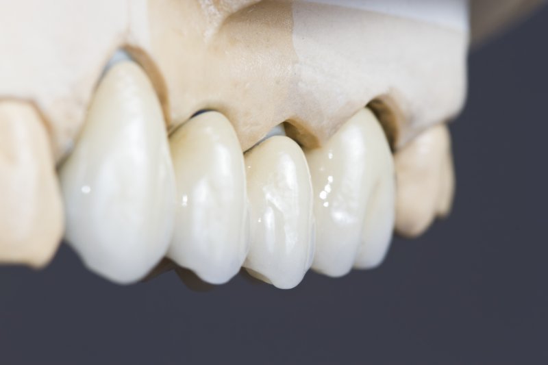 Dental bridge model