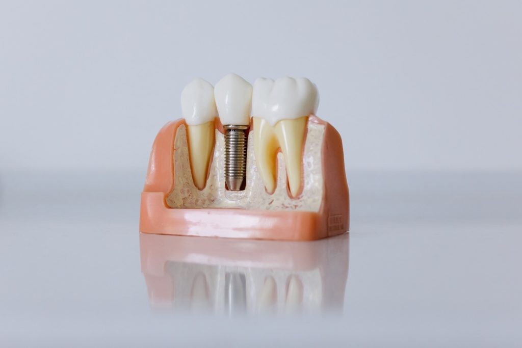 model of a dental implant