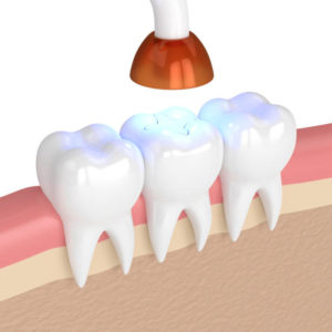 Model of tooth-colored dental filling treatment
