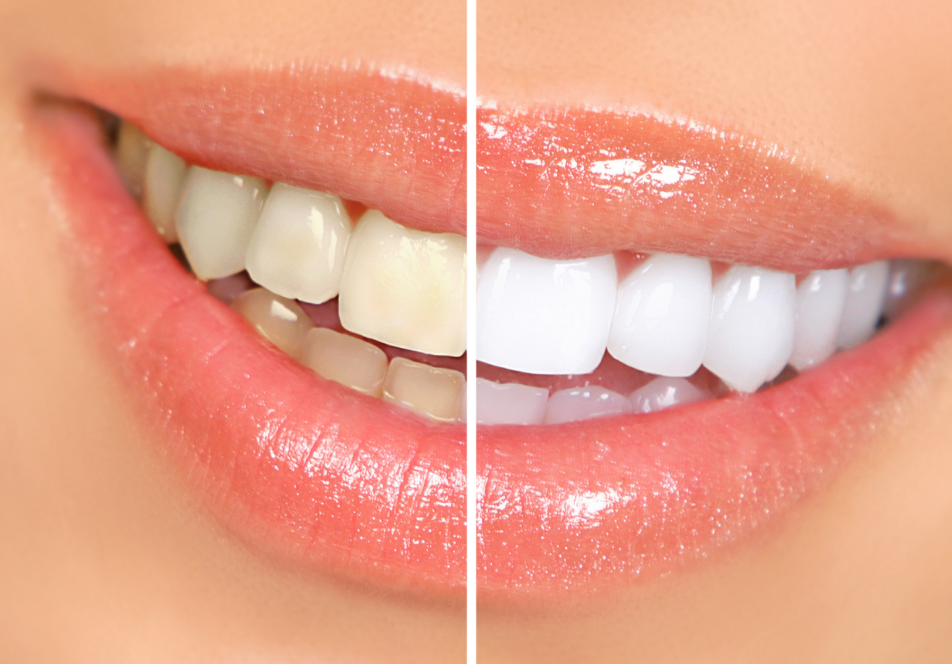 Woman's smile with half white, half yellow teeth