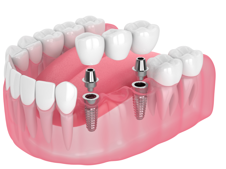 Dental implant illustration