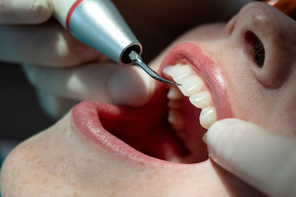 A dentist using the ultrasonic dental scaler on a patient